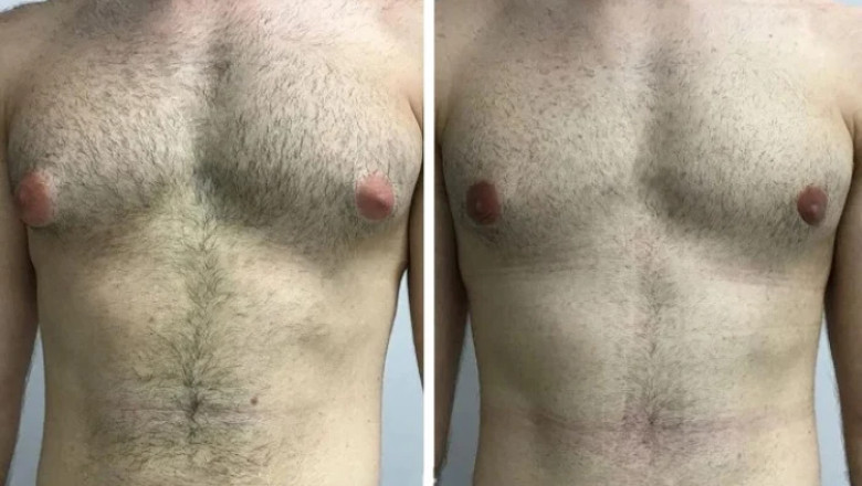 Why Experience Matters: Meet the Best Gynecomastia Surgeons in Dubai