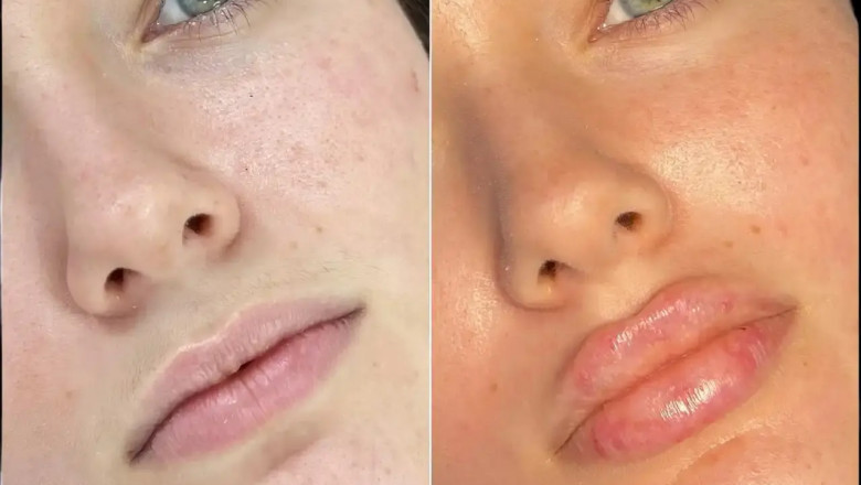 Your Journey to Beauty Starts with the Best Doctors in Dubai for Fillers
