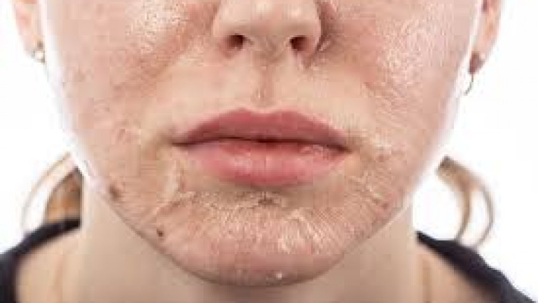 Before &amp; After: Real Results From Glamorous Clinic Peels