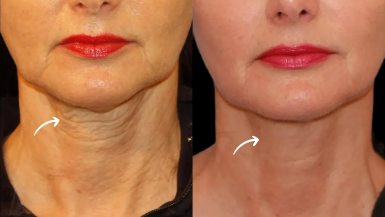 Dubai's Best Aesthetic Clinic Offers Sculptra Fillers for Athletes and Celebs
