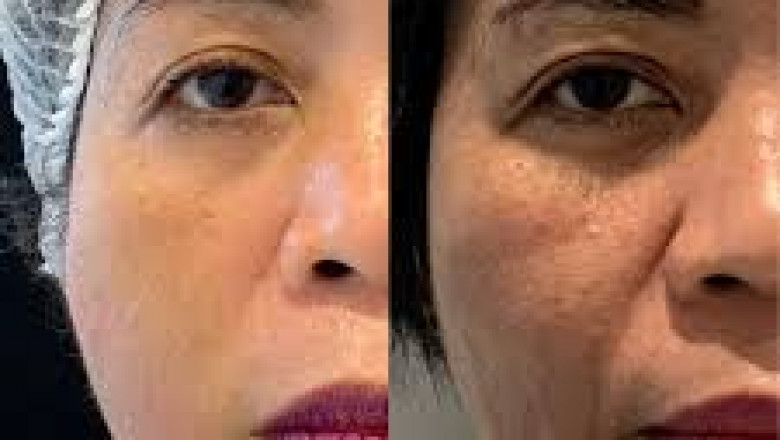 Experience a Lift at the Best Aesthetic Clinic in Dubai for Thread Lift