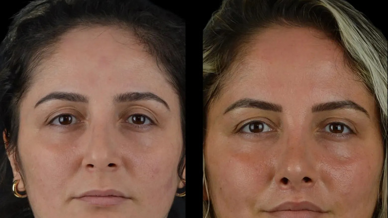 How to Get Natural-Looking Results with Cheek Fillers at the Best Aesthetic Clinic in Dubai