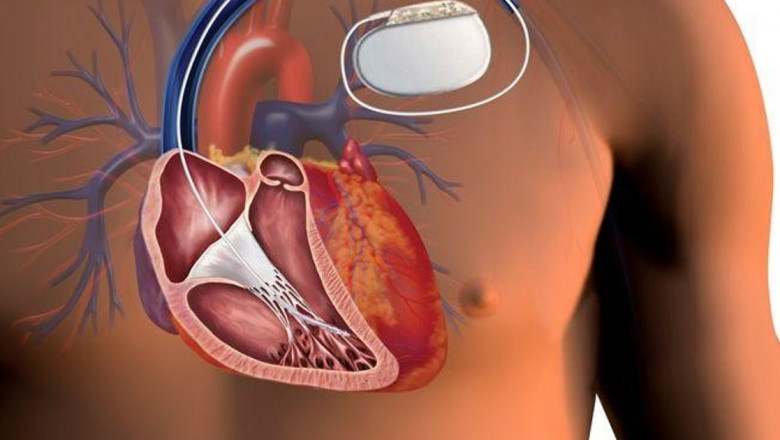 Implantable Cardiac Monitors Market to Soar with Wireless Telemetry