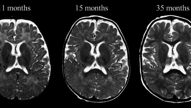 Menkes Disease Market to Surge Owing to Gene Therapy Advancements