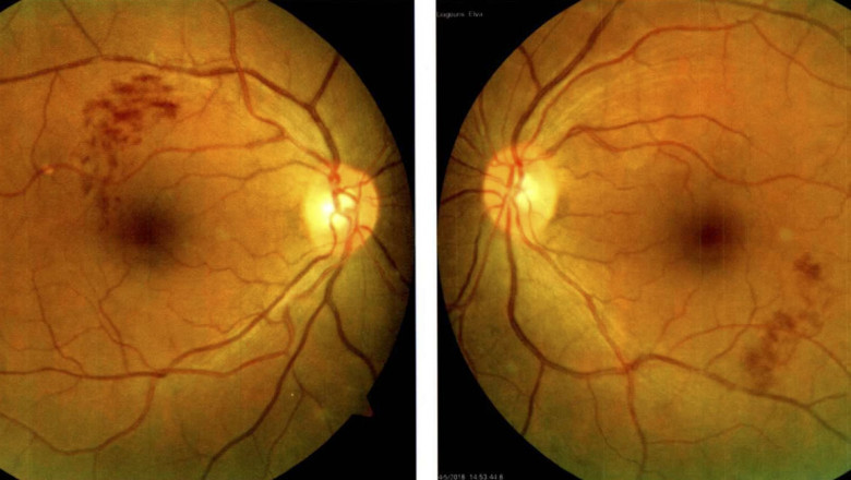 Retinal Vein Occlusion Market is Anticipated to Witness High Growth Owing to Advances in Novel Therapeutics