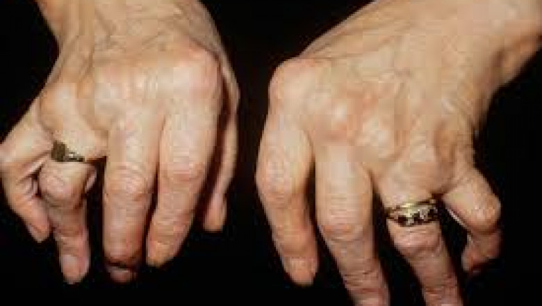 Arthritis: Types, Causes, Symptoms, Western &amp; Holistic Treatments