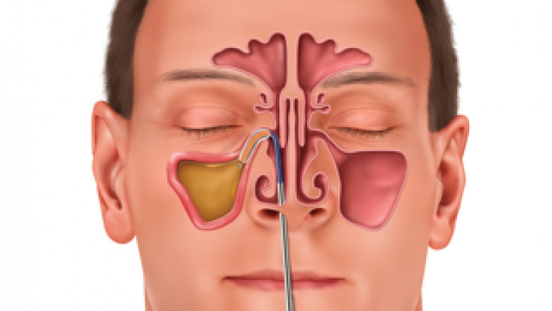 Balloon Sinuplasty Market Size Grow Exponentially To 2033
