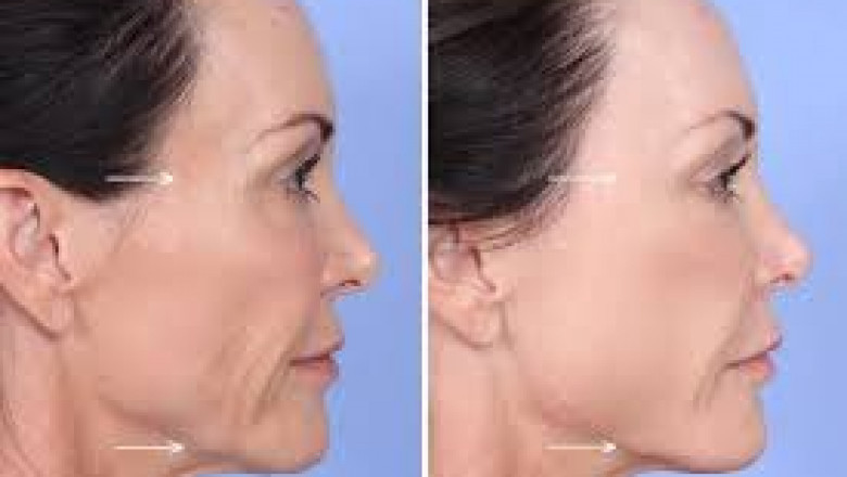 Discover the Benefits of Sculptra in Miami
