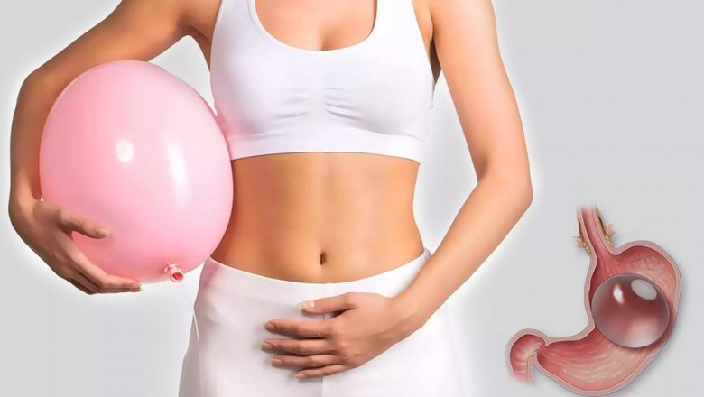 Gastric Balloon Placement and Progress