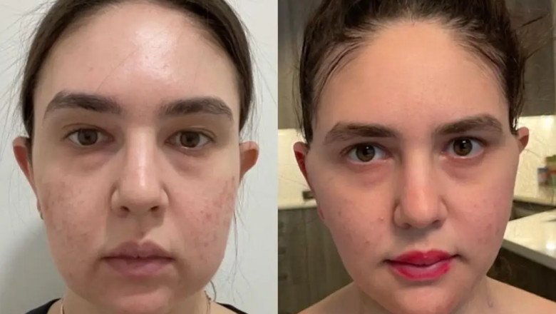 How to Tell If You’re a Good Fit for Buccal fat removal in Dubai
