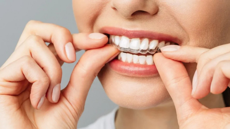 Invisalign in Dubai: The Clear Alternative to Traditional Braces