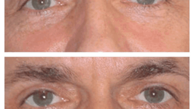 Laser Treatment for Eye bag removal in Dubai