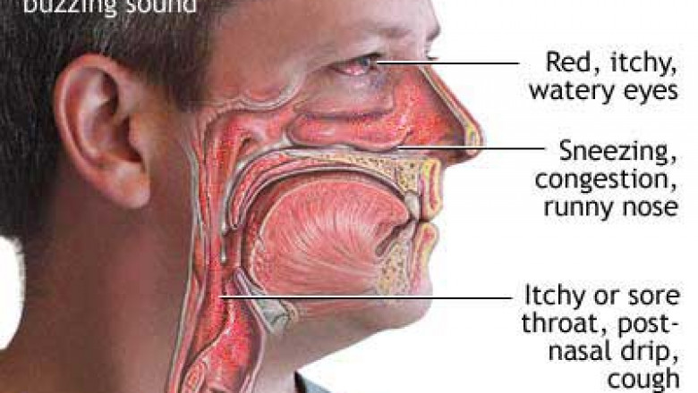 Natural Remedies for Seasonal Allergies