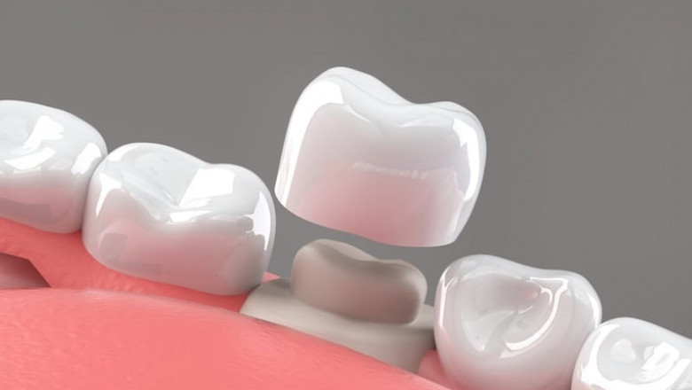 Dental Crown Cost vs. Alternative Treatments