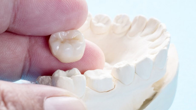 Experts Promote Awareness About Dental Crown Benefits