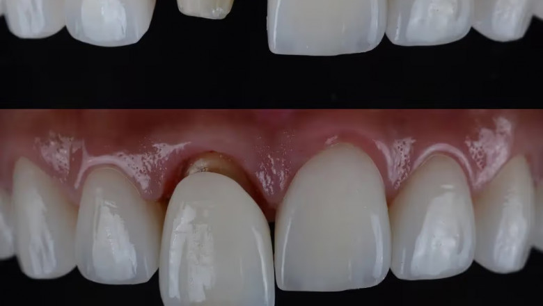 Latest Advances in Tooth Crown Technology Revealed