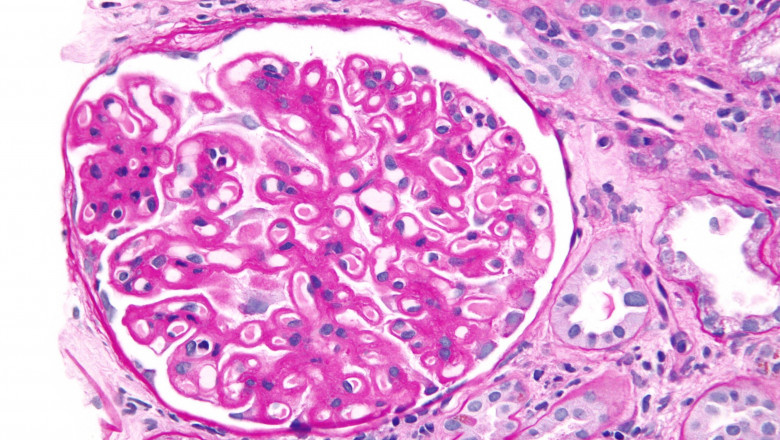 NephCure Inc.: Exploring IgA Nephropathy Treatment and Understanding Membranous Nephropathy