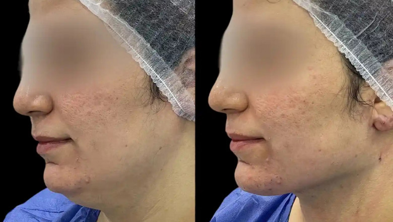 What Makes Chin Fillers in Dubai a Popular Aesthetic Treatment?