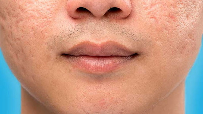 Achieve Lasting Radiance with Dubai’s Expert Large Pores Solutions