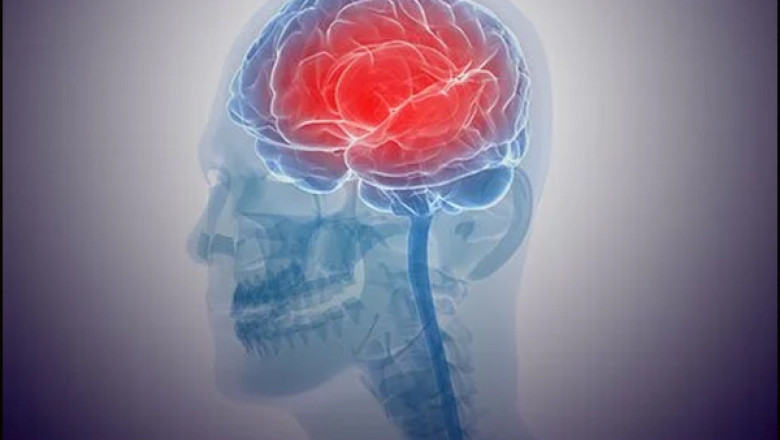 Autoimmune Encephalitis (AIE) Treatment Market to Thrive on Precision Therapeutics