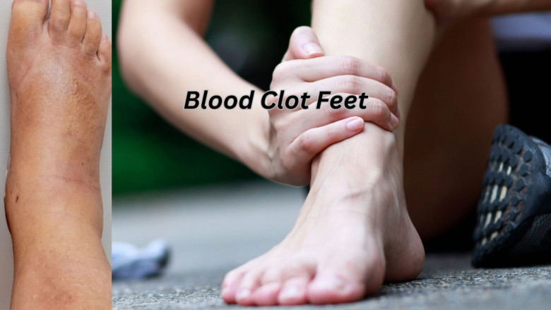 Blood Clot Feet: Tips for Management