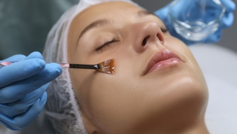 Discover the Best Chemical Peel Treatments in Hobart