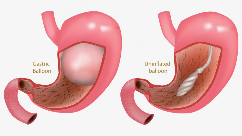 Gastric Balloon Placement for Obesity