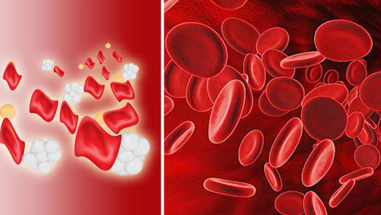 Alpha Thalassemia Market to Surge Owing to Gene Therapy
