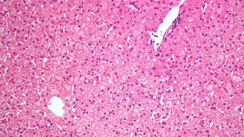 Astrocytoma Drug Market is Anticipated to Witness High Growth Owing to Innovative Targeted Therapies