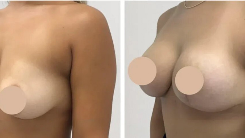 Breast Lift Results: What You Can Expect from the Best Breast Lift Surgeon in dubai