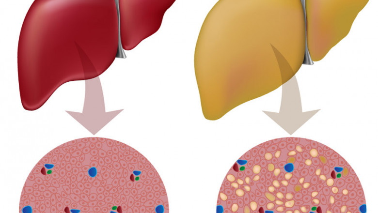 Fatty Liver Disease: Holistic Natural Treatment in Philadelphia