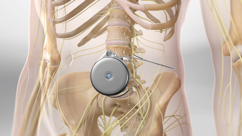 Intrathecal Therapy Market Emerging Trends, Future Demands by 2025-2033