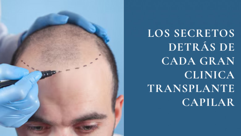 Los secretos detrás de cada gran clinica transplante capilar