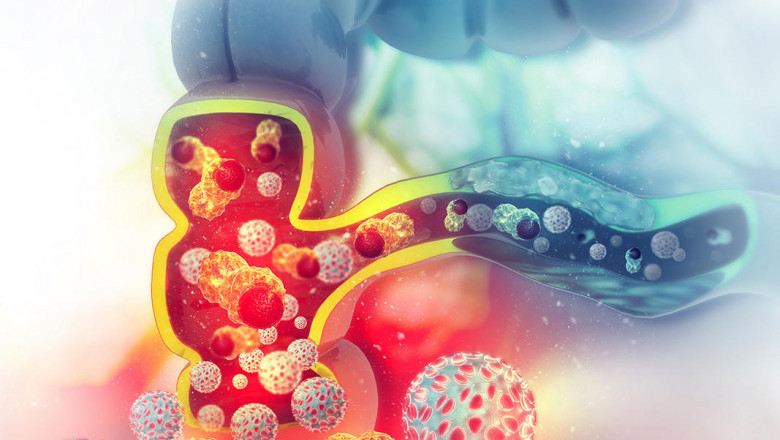 Metastatic Colorectal Cancer Market to Grow Fastest Owing to Immunotherapy Innovation