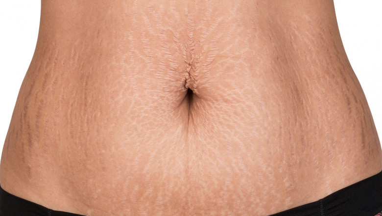 Real Stories Behind Laser Stretch Marks Treatment That Works