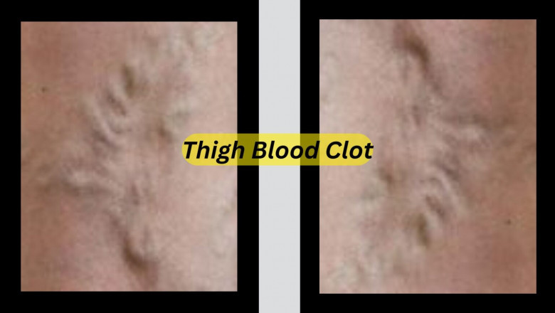 Can inner thigh pain be a blood clot?