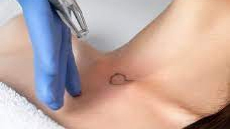 Can Laser Tattoo Removal Be Done on Any Skin Type?