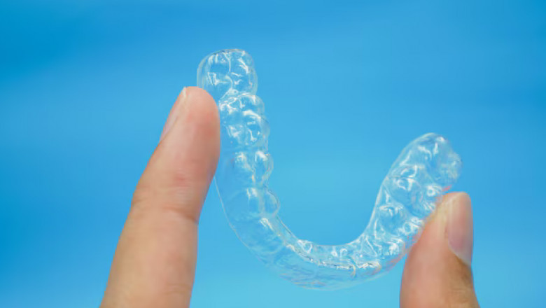 Clear Aligners Are on Your Way