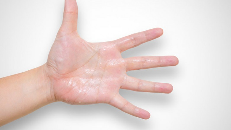 Managing Hyperhidrosis in Delhi: From Medications to Advanced Surgery