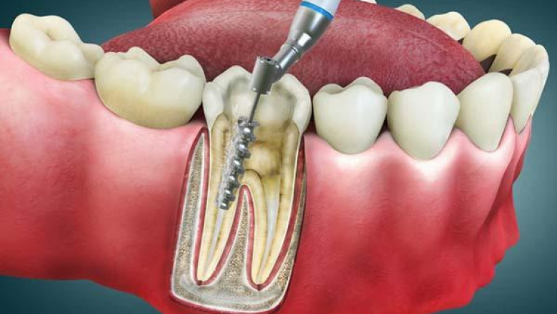 Root Canal Treatment Improves Oral Health