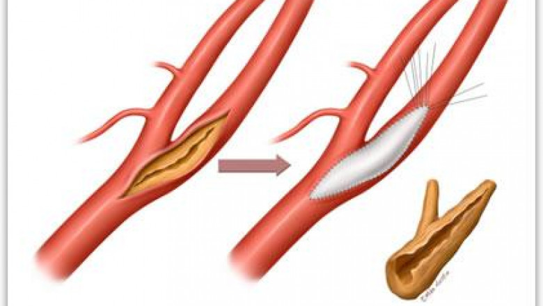 Vascular Patches Market Intelligence Unveils Industry Landscape, Competitive Strategies, and Technological Advancements Worldwide