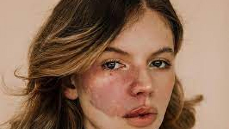 What Happens During a Birthmark Removal Procedure?