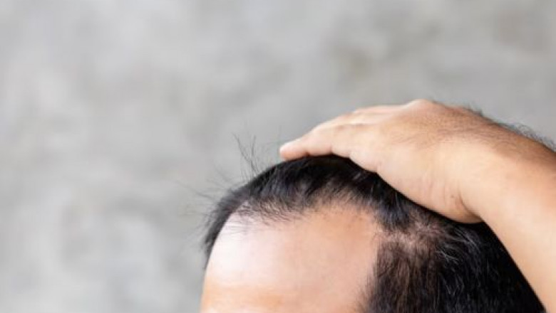 What is the Life of a Hair Transplant?