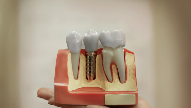Your Smile Upgrade Starts with Dental Implants