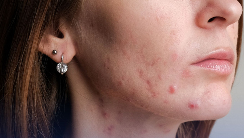 Acne Treatment Plans Tailored to Different Skin Types and Ages