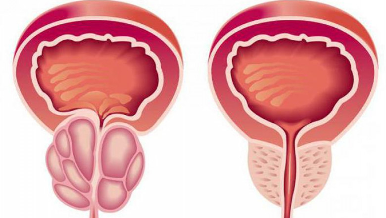 Global Sialorrhea Treatment Market Set to Expand with Botulinum Toxin Advances