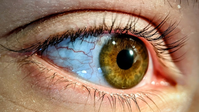 Sun and Eye Health: Do You Really Need Sunglasses?