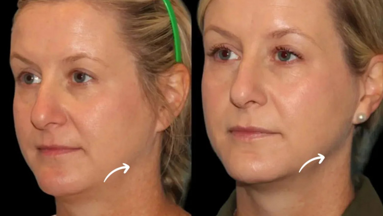 The Long-Term Skin Benefits of Sculptra Fillers Treatments in Dubai