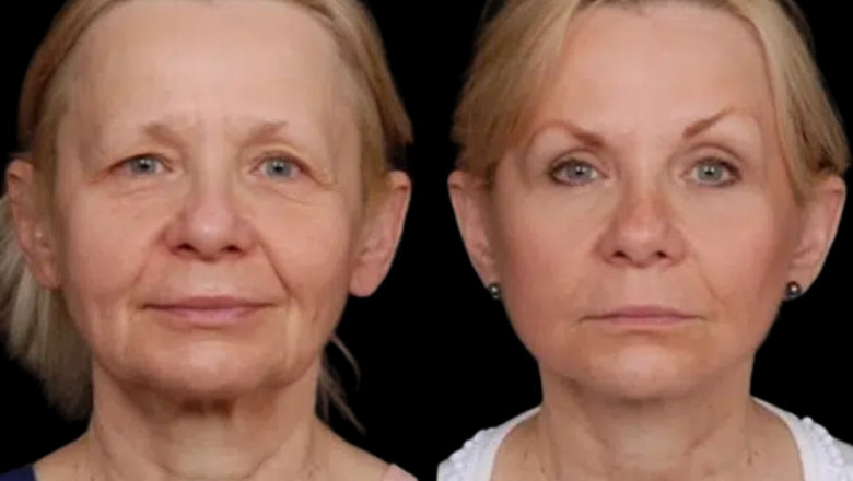 The Most Common Concerns Treated by Under Eye Fillers Treatments in Dubai
