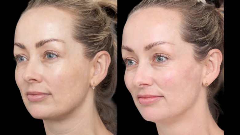 The Most Popular Types of Cheek Fillers Treatments in Dubai